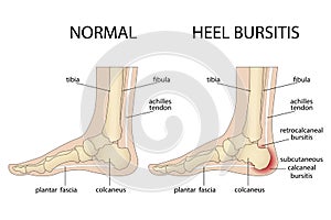 Foot with normal heel and foot with Haglund\'s deformity and bursitis. photo